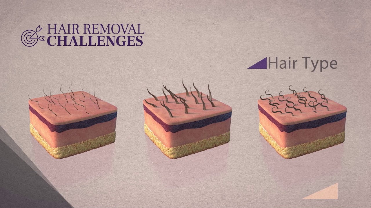 Soprano SHR 3D technology explainer video